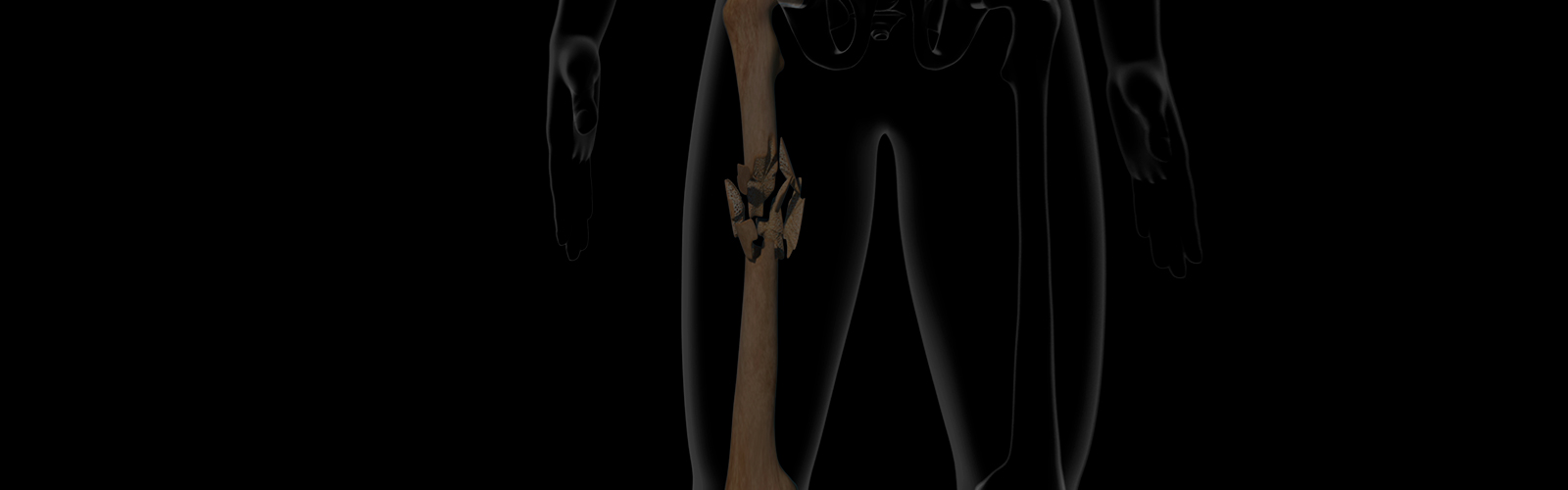 Fracturas